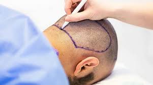 Regain Confidence with Hair Transplant: Affordable Options in Turkey