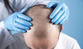 How Are Hair Transplant Costs Determined in Turkey?