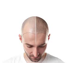 Hair Transplant Cost in Turkey: Affordable High Quality